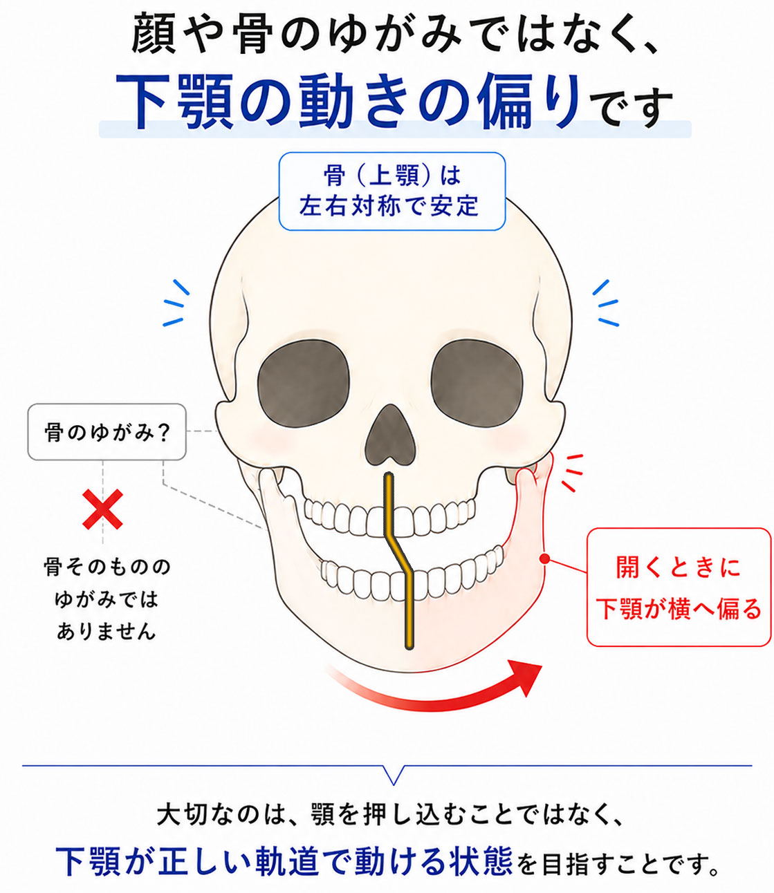 顎関節症は骨のゆがみではなく下顎の動きの偏りが関係することを説明した図